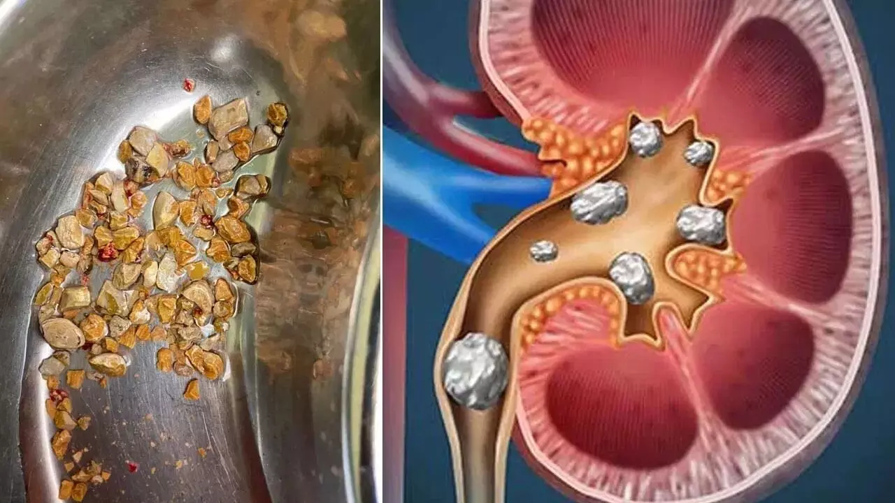 Health: కిడ్నీలో రాళ్ళు ఎవరికి వస్తాయి? Health: కిడ్నీలో రాళ్ళు ఎవరికి వస్తాయి?