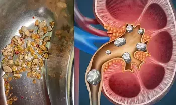 Health: కిడ్నీలో రాళ్ళు ఎవరికి వస్తాయి? Health: కిడ్నీలో రాళ్ళు ఎవరికి వస్తాయి?