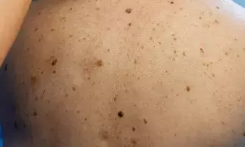 Acne: ఒక్క రాత్రిలో మొటిమలు తగ్గాలంటే ఈ ఇంటి చిట్కా వాడండి..