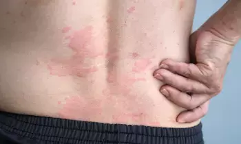 Psoriasis: అలాంటి వాళ్లకు సోరియాసిస్ వచ్చే ప్రమాదం Psoriasis: అలాంటి వాళ్లకు సోరియాసిస్ వచ్చే ప్రమాదం