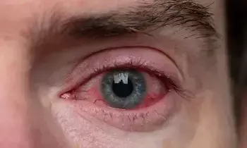 Viral Eye Infections: వైరల్ కంటి ఇన్ఫెక్షన్లకు ఎలాంటి జాగ్రత్తలు తీసుకోవాలో తెలుసా..? Viral Eye Infections: వైరల్ కంటి ఇన్ఫెక్షన్లకు ఎలాంటి జాగ్రత్తలు తీసుకోవాలో తెలుసా..?