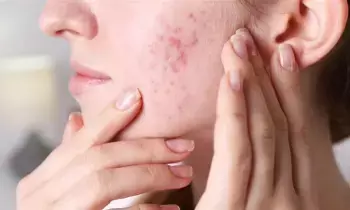 To Reduce Pimples: మొటిమలు తగ్గించే ఇంటి చిట్కాలు To Reduce Pimples: మొటిమలు తగ్గించే ఇంటి చిట్కాలు