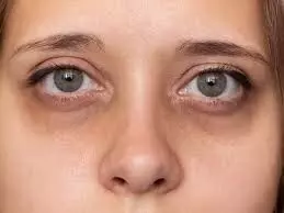 Dark Circles Around Your Eyes: కళ్ళ చుట్టూ బ్లాక్ సర్కిల్స్ పోవాలంటే.. ఈ ట్రిక్స్ పాటించండి..