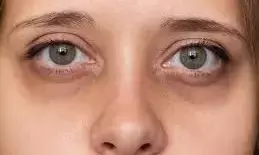 Dark Circles Around Your Eyes: కళ్ళ చుట్టూ బ్లాక్ సర్కిల్స్ పోవాలంటే.. ఈ ట్రిక్స్ పాటించండి.. Dark Circles Around Your Eyes: కళ్ళ చుట్టూ బ్లాక్ సర్కిల్స్ పోవాలంటే.. ఈ ట్రిక్స్ పాటించండి..