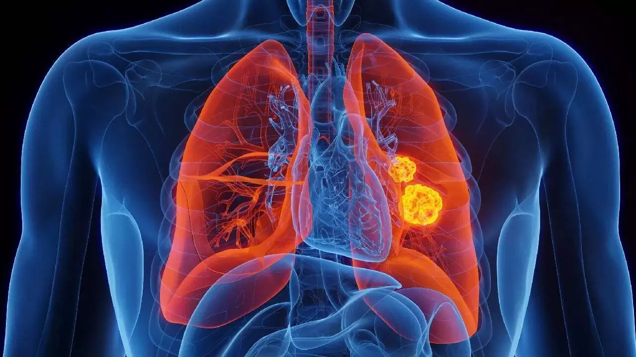 Damage Your Lungs: ధూమపానం మాత్రమే కాదు.. ఊపిరితిత్తులను దెబ్బతీసేవి ఇవే. Damage Your Lungs: ధూమపానం మాత్రమే కాదు.. ఊపిరితిత్తులను దెబ్బతీసేవి ఇవే.