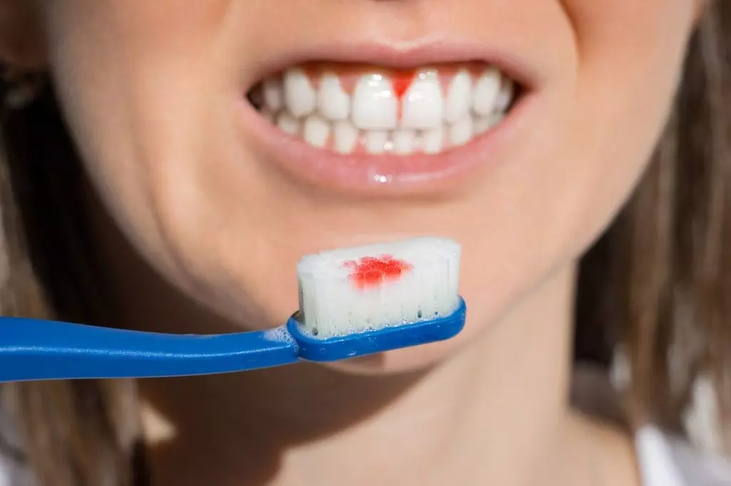 Bleeding Gums and Heart Diseases: చిగుళ్ళ రక్తస్రావం - గుండె జబ్బుల మధ్య సంబంధం ఉందా..? Bleeding Gums and Heart Diseases: చిగుళ్ళ రక్తస్రావం - గుండె జబ్బుల మధ్య సంబంధం ఉందా..?