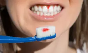 Bleeding Gums and Heart Diseases: చిగుళ్ళ రక్తస్రావం - గుండె జబ్బుల మధ్య సంబంధం ఉందా..? Bleeding Gums and Heart Diseases: చిగుళ్ళ రక్తస్రావం - గుండె జబ్బుల మధ్య సంబంధం ఉందా..?