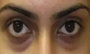 Dark Circles Under the Eyes: కళ్ల కింద నల్లటి డార్క్ సర్కిల్స్ పోవాలంటే Dark Circles Under the Eyes: కళ్ల కింద నల్లటి డార్క్ సర్కిల్స్ పోవాలంటే