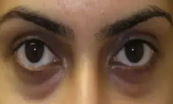 Dark Circles Under the Eyes: కళ్ల కింద నల్లటి డార్క్ సర్కిల్స్ పోవాలంటే Dark Circles Under the Eyes: కళ్ల కింద నల్లటి డార్క్ సర్కిల్స్ పోవాలంటే