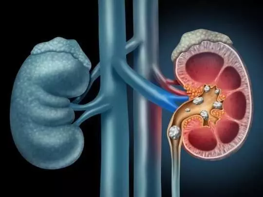 Prevent Kidney Stones: కిడ్నీలో రాళ్లు రాకుండా ఉండాలంటే ఇవి పాటించండి Prevent Kidney Stones: కిడ్నీలో రాళ్లు రాకుండా ఉండాలంటే ఇవి పాటించండి