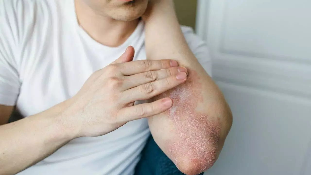 Skin Problems: వర్షాకాలంలో చర్మ సమస్యలు.. ఏం చేయాలంటే..?