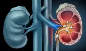 Prevent Kidney Stones: కిడ్నీలో రాళ్లు రాకుండా ఉండాలంటే ఇవి పాటించండి Prevent Kidney Stones: కిడ్నీలో రాళ్లు రాకుండా ఉండాలంటే ఇవి పాటించండి