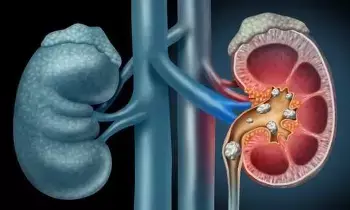Prevent Kidney Stones: కిడ్నీలో రాళ్లు రాకుండా ఉండాలంటే ఇవి పాటించండి Prevent Kidney Stones: కిడ్నీలో రాళ్లు రాకుండా ఉండాలంటే ఇవి పాటించండి