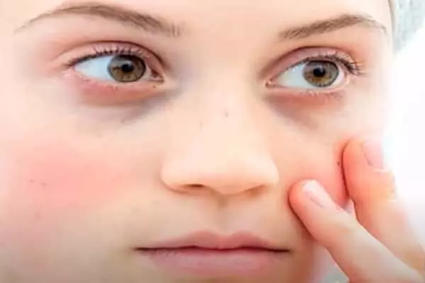 Dark Circles: ఇంటి చిట్కాలతో డార్క్ సర్కిల్స్‌కు చెక్!
