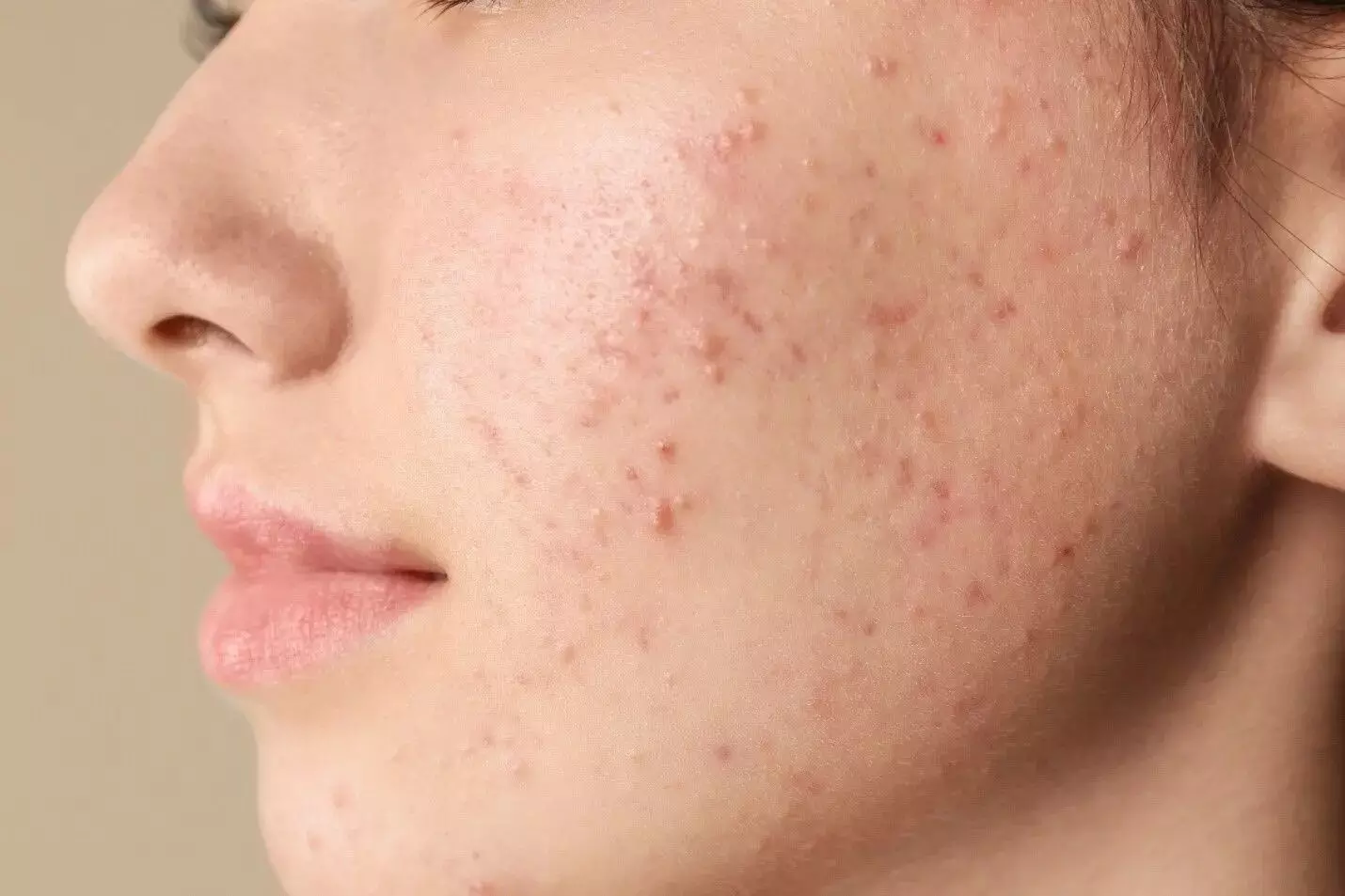 Pimples: మొటిమలు ఎందుకొస్తాయో తెలుసా.? Pimples: మొటిమలు ఎందుకొస్తాయో తెలుసా.?