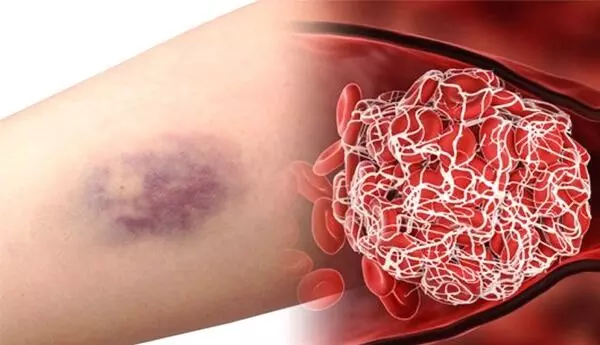 Blood Clot: రక్తం ఎందుకు గడ్డ కడుతుంది.? Blood Clot: రక్తం ఎందుకు గడ్డ కడుతుంది.?