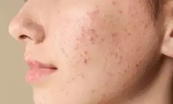 Pimples: మొటిమలు ఎందుకొస్తాయో తెలుసా.? Pimples: మొటిమలు ఎందుకొస్తాయో తెలుసా.?