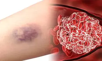 Blood Clot: రక్తం ఎందుకు గడ్డ కడుతుంది.? Blood Clot: రక్తం ఎందుకు గడ్డ కడుతుంది.?