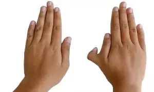 Having Six Fingers on the Right Hand: కుడి చేతిలో ఆరు వేళ్లు ఉంటే అదృష్టమా..? అశుభమా..? Having Six Fingers on the Right Hand: కుడి చేతిలో ఆరు వేళ్లు ఉంటే అదృష్టమా..? అశుభమా..?