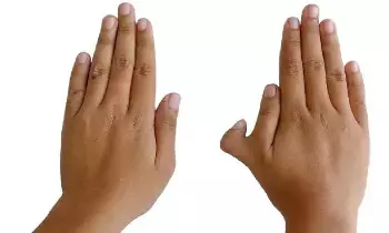 Having Six Fingers on the Right Hand: కుడి చేతిలో ఆరు వేళ్లు ఉంటే అదృష్టమా..? అశుభమా..? Having Six Fingers on the Right Hand: కుడి చేతిలో ఆరు వేళ్లు ఉంటే అదృష్టమా..? అశుభమా..?