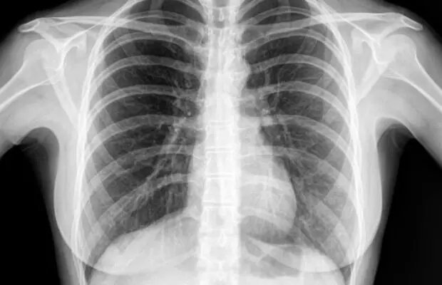 Getting a Chest X-Ray: చెస్ట్ ఎక్స్ రే తీయించుకుంటున్నారా? ఈ విషయం తెలుసుకోండి