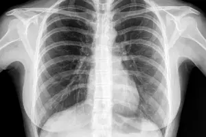 Getting a Chest X-Ray: చెస్ట్ ఎక్స్ రే తీయించుకుంటున్నారా? ఈ విషయం తెలుసుకోండి
