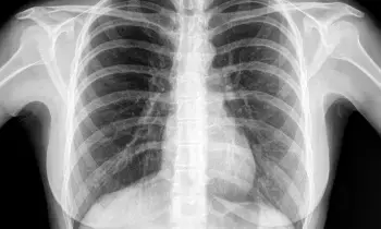 Getting a Chest X-Ray: చెస్ట్ ఎక్స్ రే తీయించుకుంటున్నారా? ఈ విషయం తెలుసుకోండి