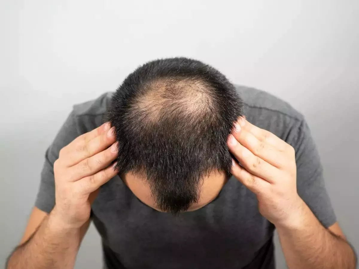 Baldness Is Certain: ఈ లక్షణాలుంటే..మీకు బట్టతల రావడం ఖాయం Baldness Is Certain: ఈ లక్షణాలుంటే..మీకు బట్టతల రావడం ఖాయం