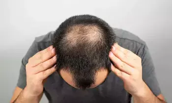 Baldness Is Certain: ఈ లక్షణాలుంటే..మీకు బట్టతల రావడం ఖాయం Baldness Is Certain: ఈ లక్షణాలుంటే..మీకు బట్టతల రావడం ఖాయం
