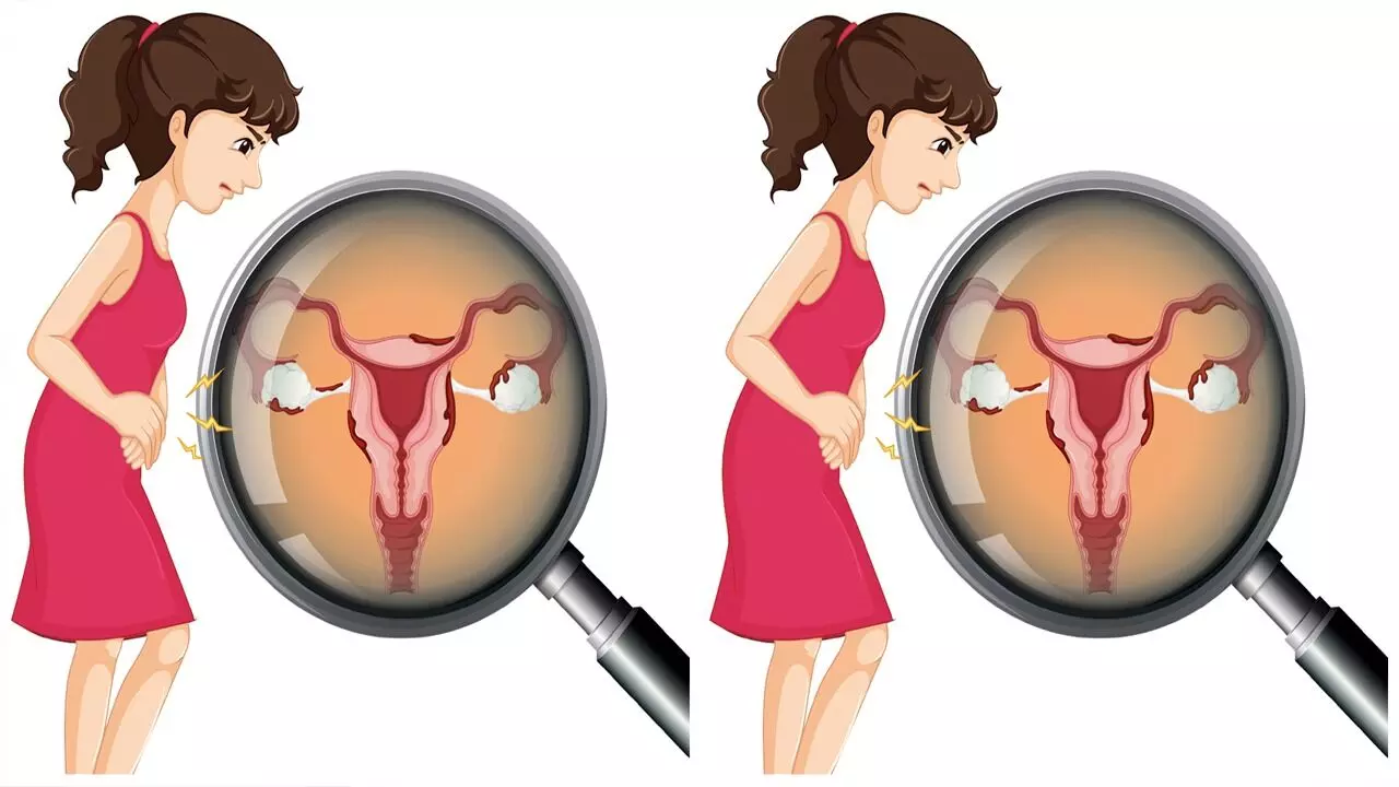 Uterus Slip Down: గర్భసంచి కిందికి ఎందుకు జారుతుంది.?