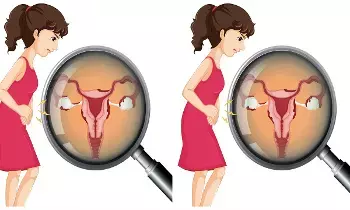 Uterus Slip Down: గర్భసంచి కిందికి ఎందుకు జారుతుంది.? Uterus Slip Down: గర్భసంచి కిందికి ఎందుకు జారుతుంది.?