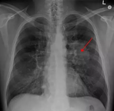 Lung Cancer : పొగాకు ముట్టనివారిని కబలిస్తున్న లంగ్ క్యాన్సర్ Lung Cancer : పొగాకు ముట్టనివారిని కబలిస్తున్న లంగ్ క్యాన్సర్
