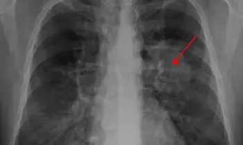 Lung Cancer : పొగాకు ముట్టనివారిని కబలిస్తున్న లంగ్ క్యాన్సర్