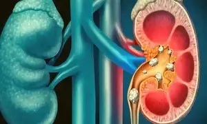 Kidney Stones Recur Again and Again: కిడ్నీలో రాళ్లు మళ్లీ మళ్లీ వస్తున్నాయా? ఈ 5 జాగ్రత్తలతో వాటికి చెక్ పెట్టండి Kidney Stones Recur Again and Again: కిడ్నీలో రాళ్లు మళ్లీ మళ్లీ వస్తున్నాయా? ఈ 5 జాగ్రత్తలతో వాటికి చెక్ పెట్టండి