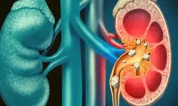 Kidney Stones Recur Again and Again: కిడ్నీలో రాళ్లు మళ్లీ మళ్లీ వస్తున్నాయా? ఈ 5 జాగ్రత్తలతో వాటికి చెక్ పెట్టండి