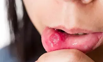 Mouth Ulcer: నోటి పూత తగ్గడం లేదా?..ఈ టిప్స్ పాటించండి