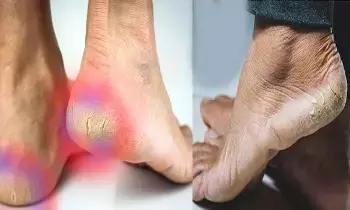 Heels Cracking: మడమలు పగులుతున్నాయా? అయితే ఈ చిట్కా ఫాలోకండి