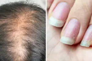 Protein Deficiency in the Body: శరీరంలో ప్రోటీన్ తగ్గుతోందని చెప్పే 6 హెచ్చరికలు.. వీటిని నిర్లక్ష్యం చేయొద్దు..