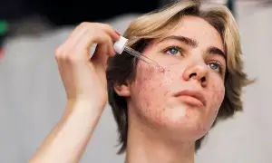 Troubled by Warts : మొటిమల సమస్య వేధిస్తోందా? మీ అలవాట్లే దానికి కారణం కావచ్చు..