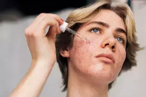 Troubled by Warts : మొటిమల సమస్య వేధిస్తోందా? మీ అలవాట్లే దానికి కారణం కావచ్చు..