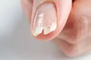 Prevent Your Nails from Breaking: గోర్లు విరిగిపోకుండా ఉండాలంటే ఈ చిట్కాలు ఫాలో కండి