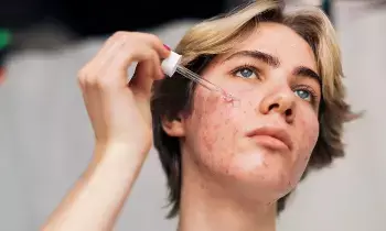 Troubled by Warts : మొటిమల సమస్య వేధిస్తోందా? మీ అలవాట్లే దానికి కారణం కావచ్చు..