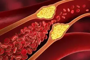 High Cholesterol Risk: అధిక కొలెస్ట్రాల్‌తో ముప్పు.. ఈ లక్షణాలు కనిపిస్తే వెంటనే అలర్ట్ అవ్వండి..