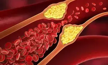 High Cholesterol Risk: అధిక కొలెస్ట్రాల్‌తో ముప్పు.. ఈ లక్షణాలు కనిపిస్తే వెంటనే అలర్ట్ అవ్వండి..