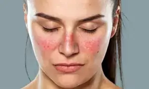 Higher Risk of Lupus in Women:  మహిళల్లో అధికంగా లూపస్ ముప్పు: లక్షణాలు ఇవే!