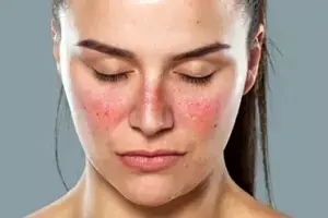 Higher Risk of Lupus in Women:  మహిళల్లో అధికంగా లూపస్ ముప్పు: లక్షణాలు ఇవే!