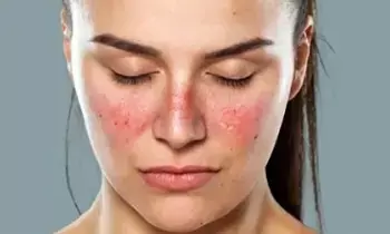 Higher Risk of Lupus in Women:  మహిళల్లో అధికంగా లూపస్ ముప్పు: లక్షణాలు ఇవే!