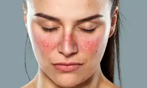 Higher Risk of Lupus in Women:  మహిళల్లో అధికంగా లూపస్ ముప్పు: లక్షణాలు ఇవే!