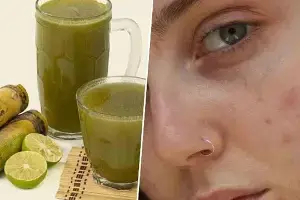 Sugarcane Juice: చెరుకు రసంతో.. మొటిమలకు ఇలా  చెక్ పెట్టండి