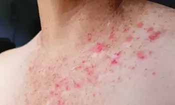 Frequent Skin Rashes: చర్మంపై తరచుగా దద్దుర్లు వస్తున్నాయా? అలెర్జీ అని విస్మరించకండి.. అసలు కారణాలు ఇవే..
